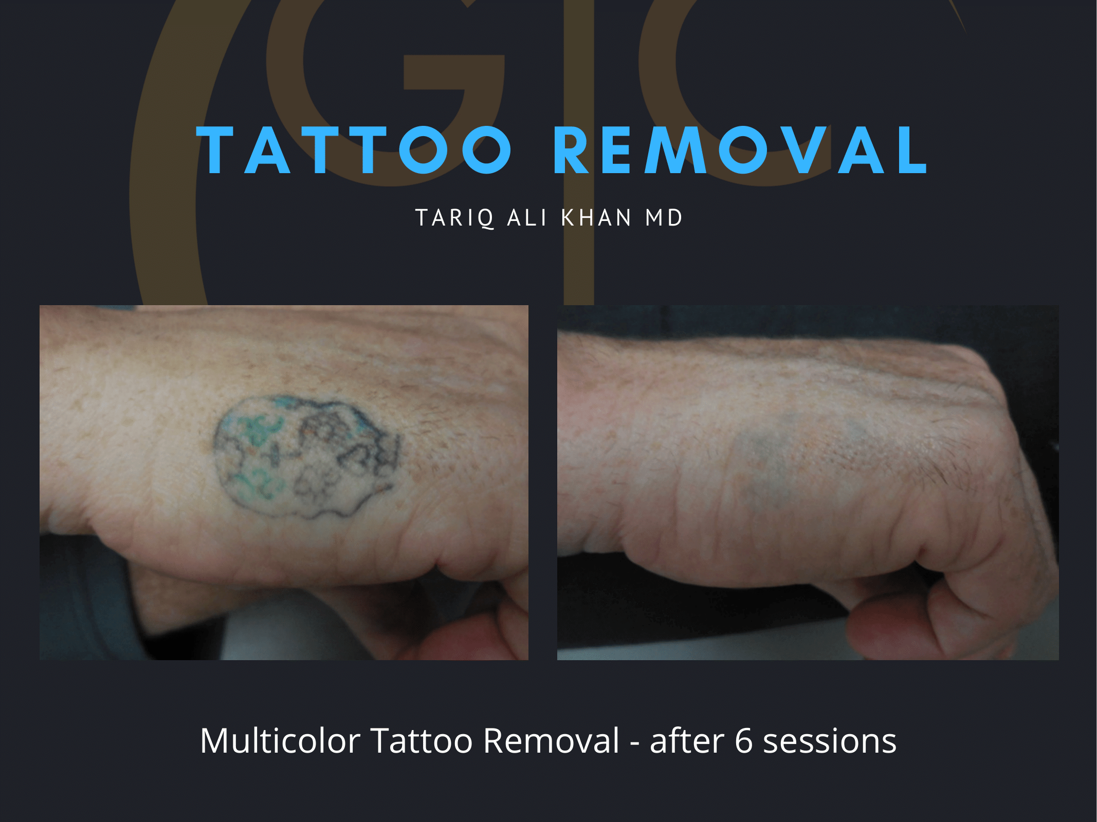 Gentle Care Laser Tustin Before and After picture - Tattoo Removal